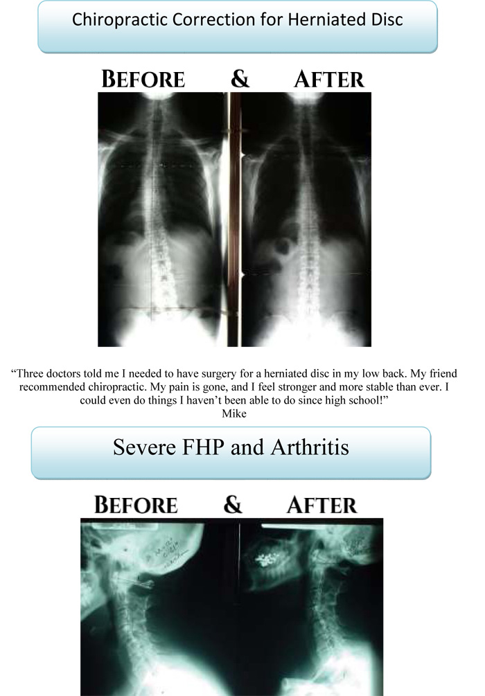Before & After XRays Aspen Ridge Chiropractic