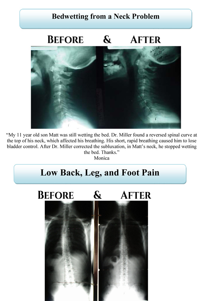Before & After XRays Aspen Ridge Chiropractic