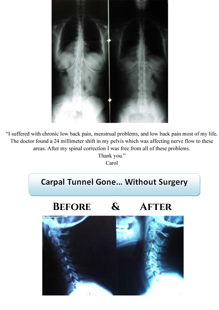 Before & After XRays Aspen Ridge Chiropractic